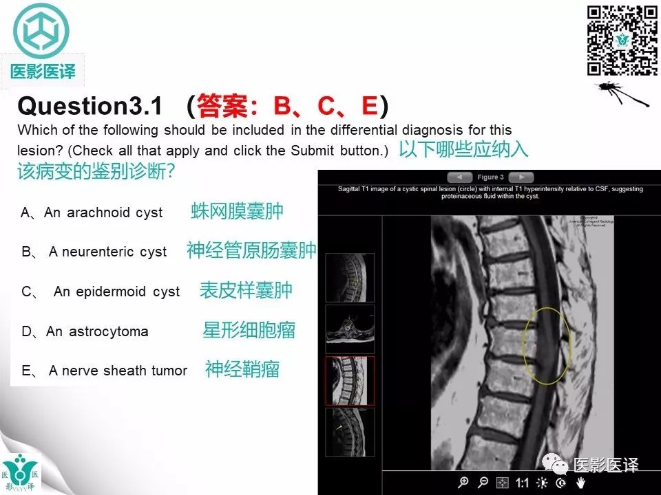 【病例】椎管神经管原肠囊肿1例MR