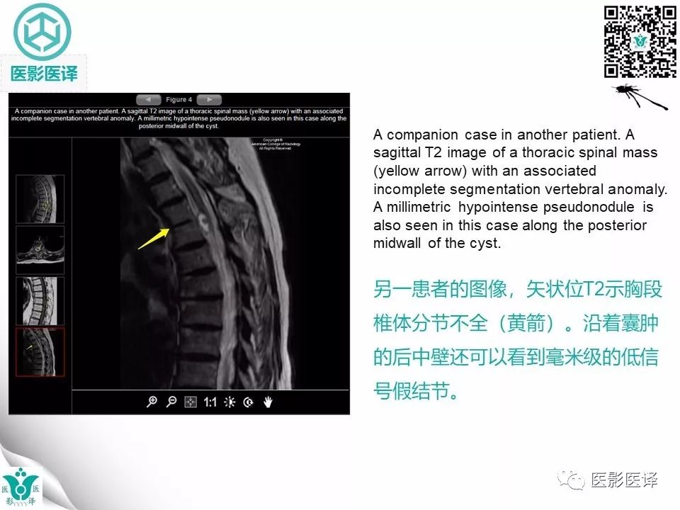 【病例】椎管神经管原肠囊肿1例MR