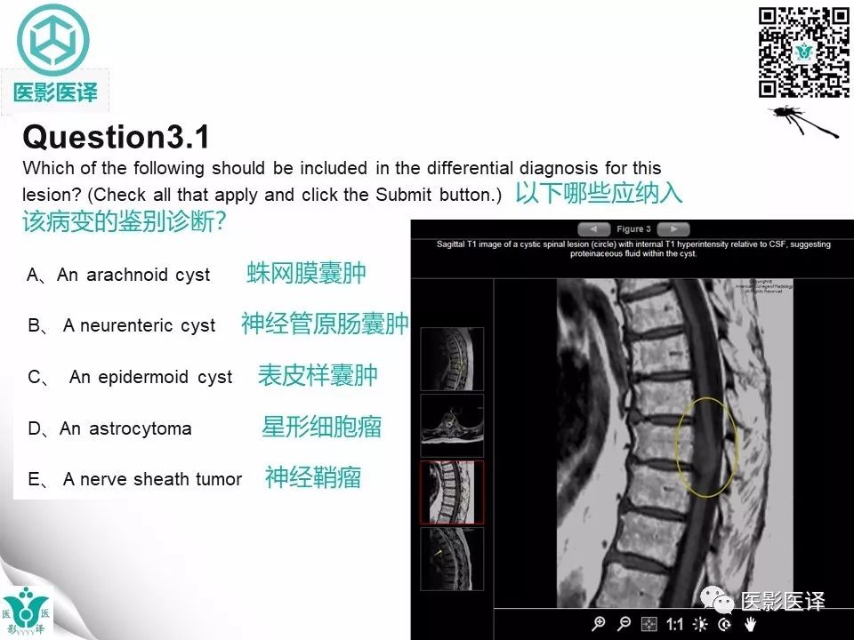 【病例】椎管神经管原肠囊肿1例MR