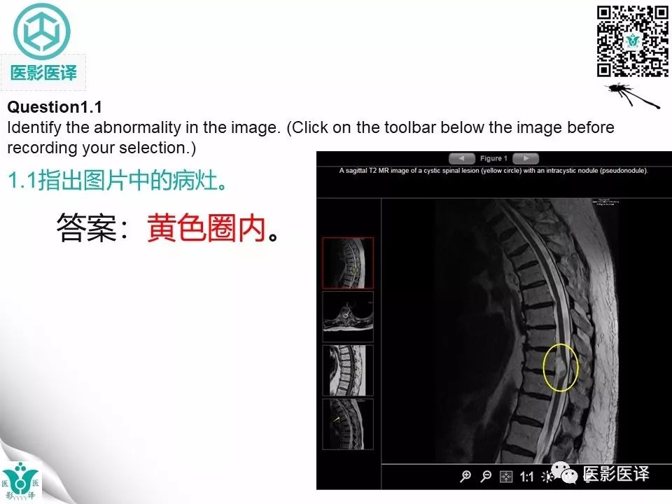 【病例】椎管神经管原肠囊肿1例MR
