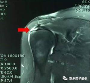 【病例】肩关节损伤疾病10例MR分析
