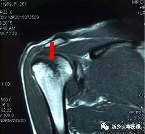 【病例】肩关节损伤疾病10例MR分析