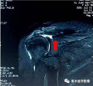 【病例】肩关节损伤疾病10例MR分析