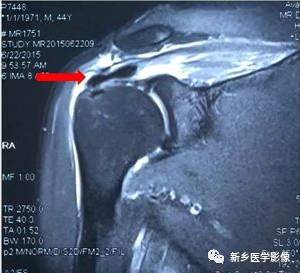【病例】肩关节损伤疾病10例MR分析