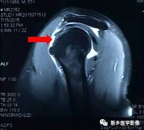 【病例】肩关节损伤疾病10例MR分析