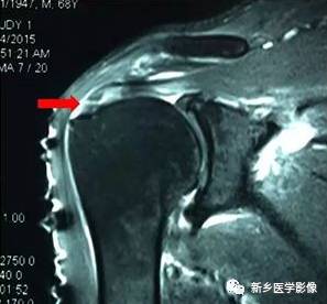 【病例】肩关节损伤疾病10例MR分析