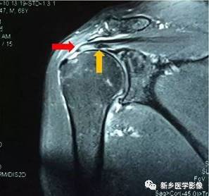 【病例】肩关节损伤疾病10例MR分析