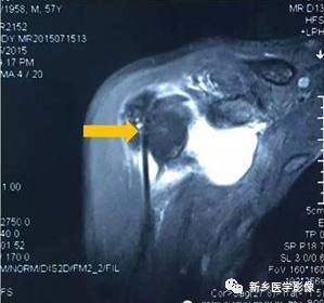 【病例】肩关节损伤疾病10例MR分析