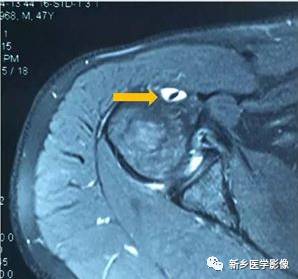 【病例】肩关节损伤疾病10例MR分析
