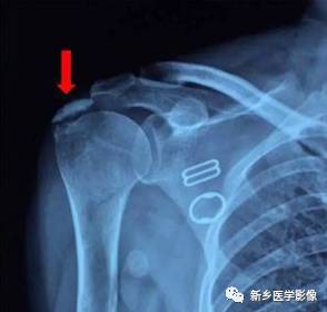 【病例】肩关节损伤疾病10例MR分析