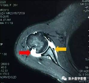 【病例】肩关节损伤疾病10例MR分析