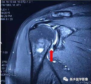 【病例】肩关节损伤疾病10例MR分析