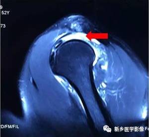 【病例】肩关节损伤疾病10例MR分析