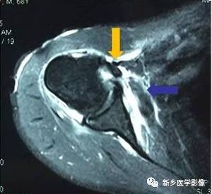 【病例】肩关节损伤疾病10例MR分析