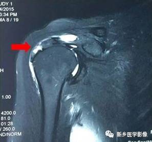 【病例】肩关节损伤疾病10例MR分析