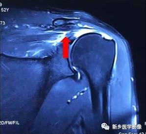 【病例】肩关节损伤疾病10例MR分析