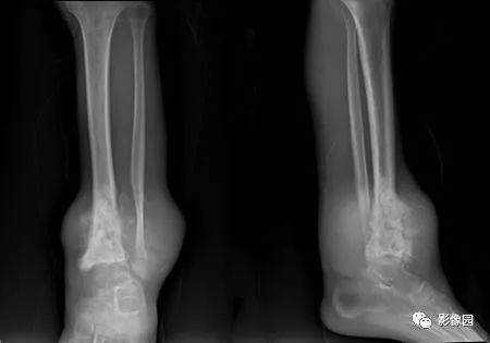 【病例】胫骨骨肉瘤1例X线CT及MR影像诊断