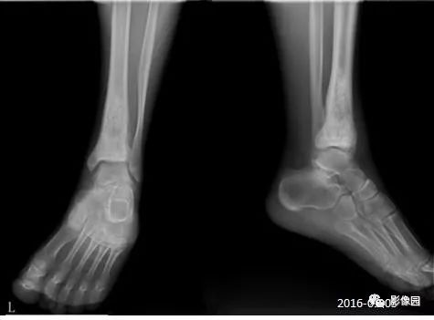 【病例】胫骨骨肉瘤1例X线CT及MR影像诊断
