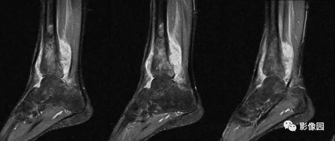 【病例】胫骨骨肉瘤1例X线CT及MR影像诊断