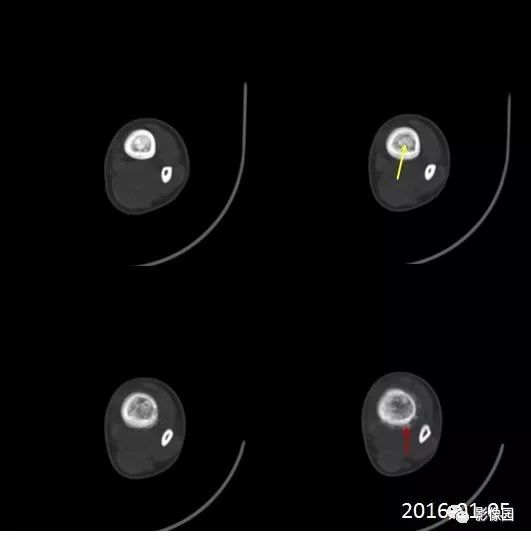 【病例】胫骨骨肉瘤1例X线CT及MR影像诊断