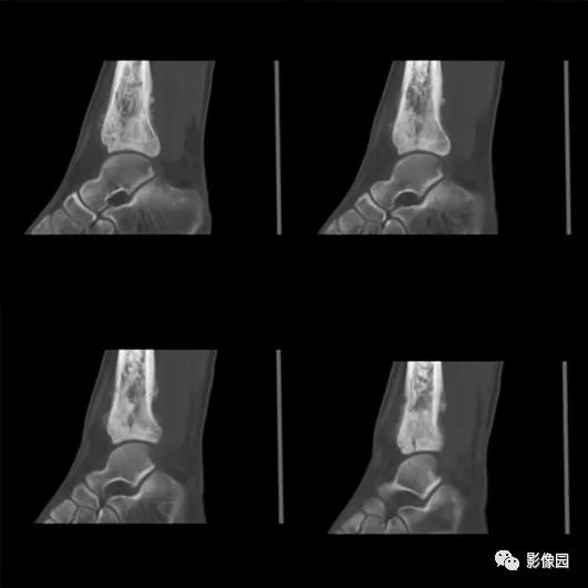 【病例】胫骨骨肉瘤1例X线CT及MR影像诊断