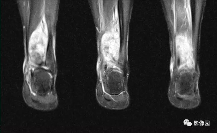 【病例】胫骨骨肉瘤1例X线CT及MR影像诊断
