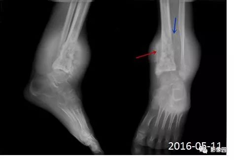 【病例】胫骨骨肉瘤1例X线CT及MR影像诊断