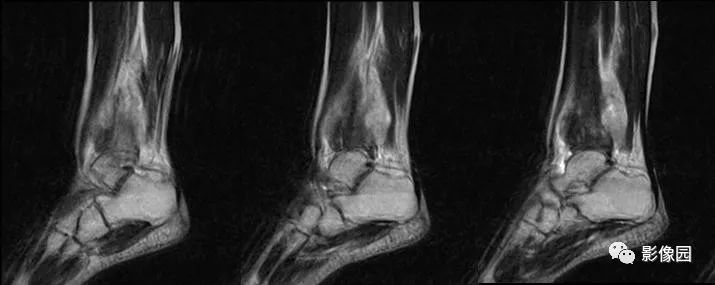 【病例】胫骨骨肉瘤1例X线CT及MR影像诊断