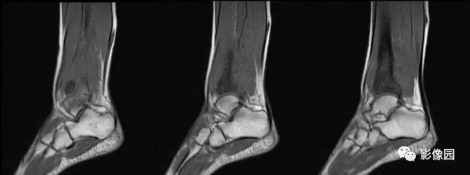 【病例】胫骨骨肉瘤1例X线CT及MR影像诊断