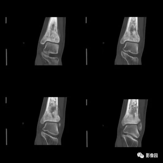 【病例】胫骨骨肉瘤1例X线CT及MR影像诊断