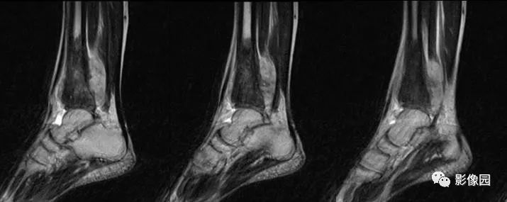 【病例】胫骨骨肉瘤1例X线CT及MR影像诊断