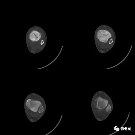 【病例】胫骨骨肉瘤1例X线CT及MR影像诊断