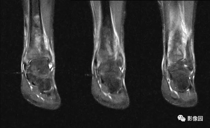【病例】胫骨骨肉瘤1例X线CT及MR影像诊断