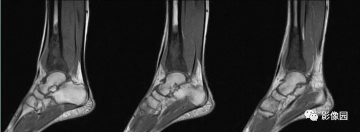 【病例】胫骨骨肉瘤1例X线CT及MR影像诊断