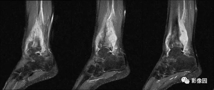 【病例】胫骨骨肉瘤1例X线CT及MR影像诊断