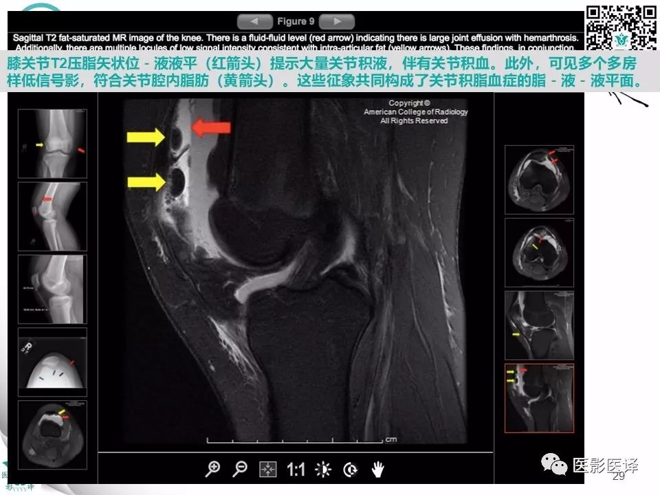 【病例】急性滑脱性髌股撞击症1例X线MR
