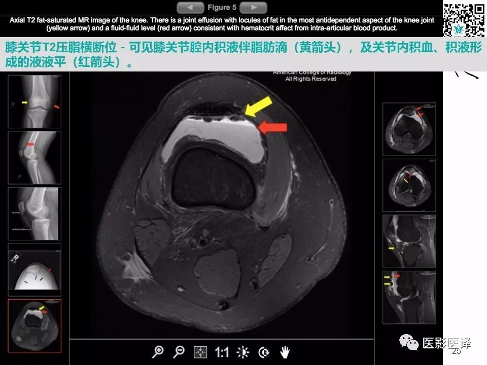 【病例】急性滑脱性髌股撞击症1例X线MR