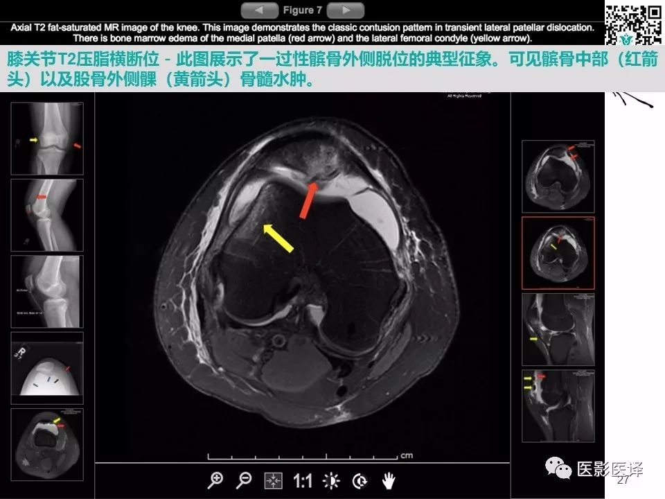 【病例】急性滑脱性髌股撞击症1例X线MR