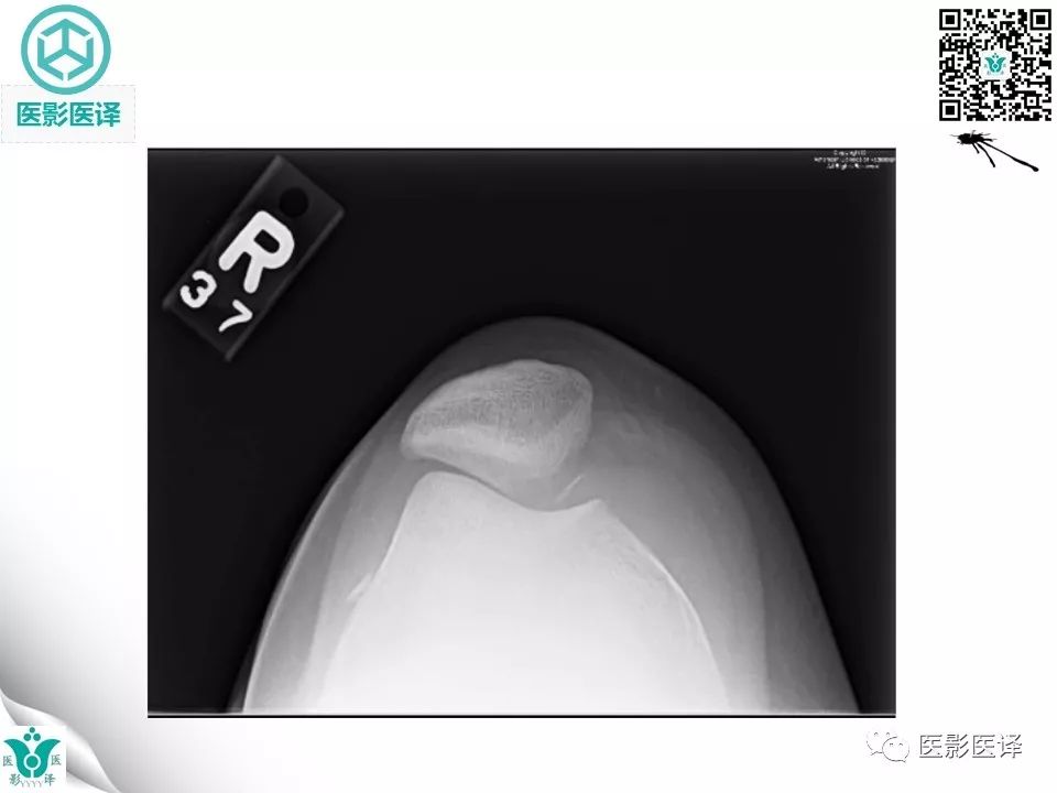 【病例】急性滑脱性髌股撞击症1例X线MR