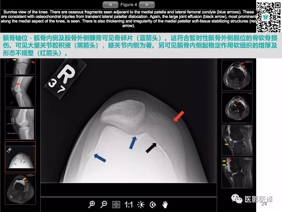 【病例】急性滑脱性髌股撞击症1例X线MR