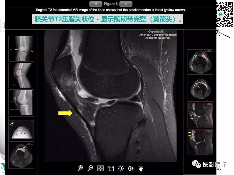 【病例】急性滑脱性髌股撞击症1例X线MR