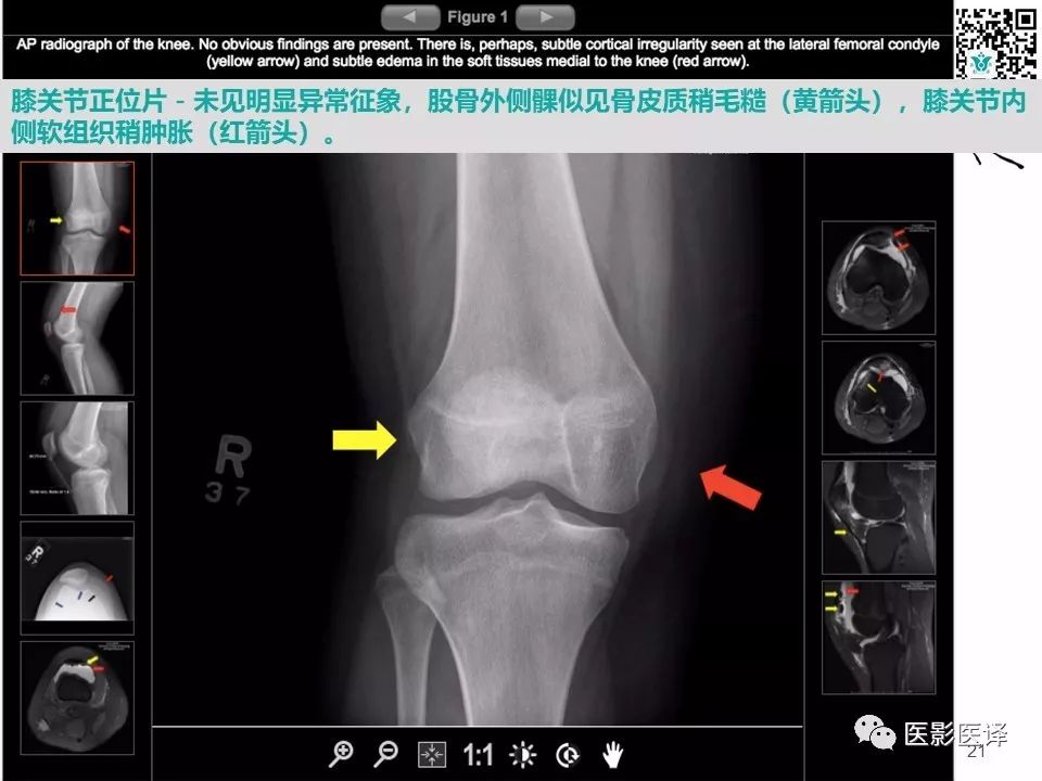 【病例】急性滑脱性髌股撞击症1例X线MR