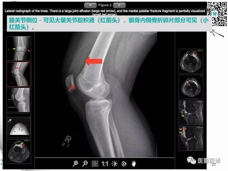 【病例】急性滑脱性髌股撞击症1例X线MR