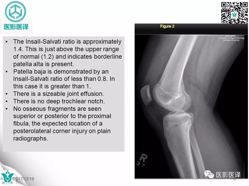 【病例】急性滑脱性髌股撞击症1例X线MR