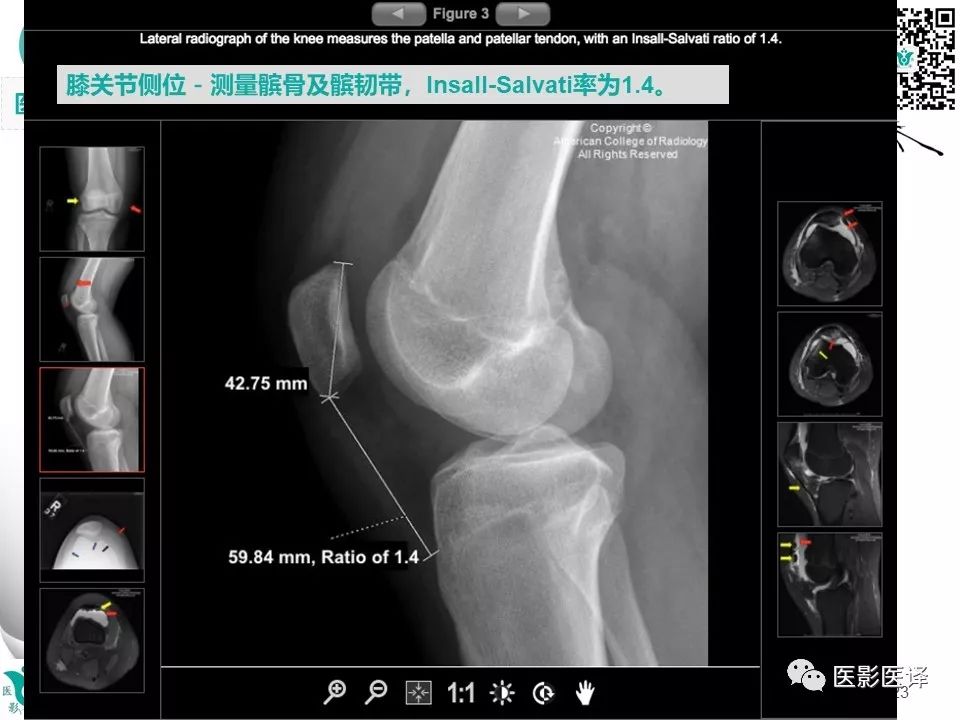 【病例】急性滑脱性髌股撞击症1例X线MR