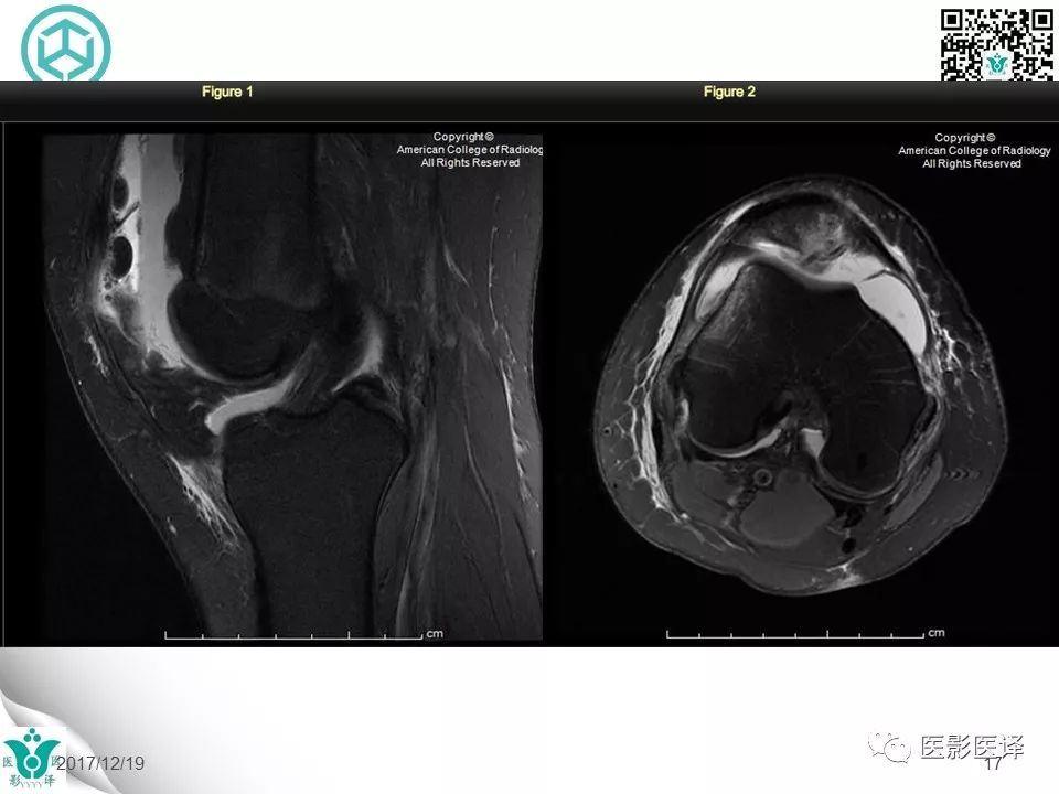 【病例】急性滑脱性髌股撞击症1例X线MR