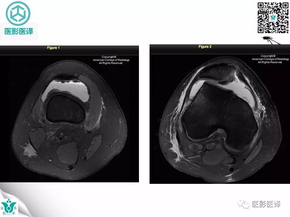 【病例】急性滑脱性髌股撞击症1例X线MR