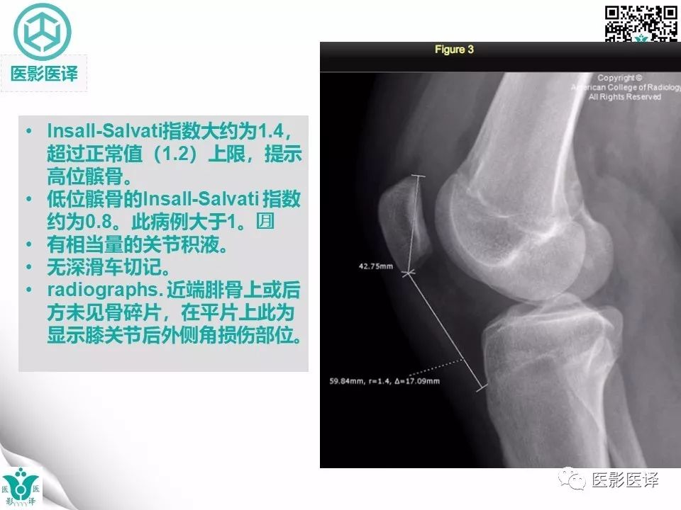 【病例】急性滑脱性髌股撞击症1例X线MR