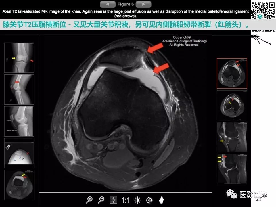 【病例】急性滑脱性髌股撞击症1例X线MR