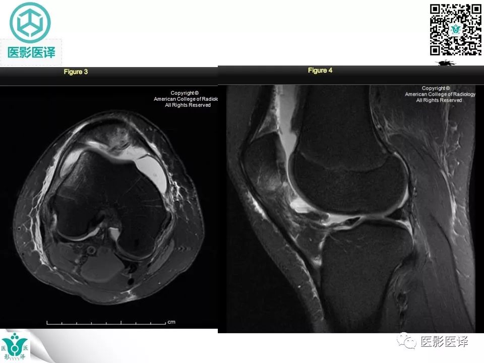 【病例】急性滑脱性髌股撞击症1例X线MR